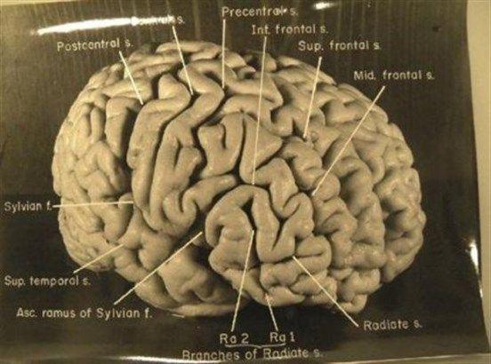 Η δομή του εγκεφάλου του Αϊνστάιν ήταν διαφορετική από του μέσου ανθρώπου